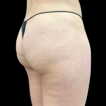 Aveli (Cellulite Removal) Before & After Patient #9242