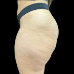 Aveli (Cellulite Removal) Before & After Patient #9249