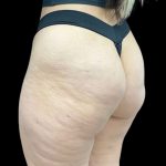 Aveli (Cellulite Removal) Before & After Patient #9249