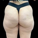 Aveli (Cellulite Removal) Before & After Patient #9249