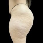 Aveli (Cellulite Removal) Before & After Patient #9249