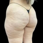 Aveli (Cellulite Removal) Before & After Patient #9249