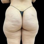 Aveli (Cellulite Removal) Before & After Patient #9249
