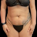 Tummy Tuck Before & After Patient #6326