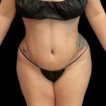 Tummy Tuck Before & After Patient #6326