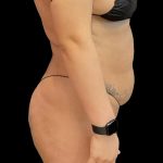 Tummy Tuck Before & After Patient #6326