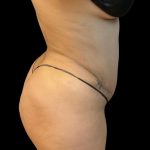 Tummy Tuck Before & After Patient #6326