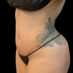 Tummy Tuck Before & After Patient #6326