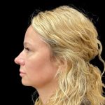 Vivace Before & After Patient #9195