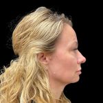 Vivace Before & After Patient #9195