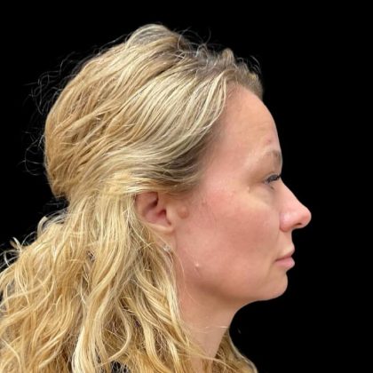 Vivace Before & After Patient #9195