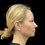 Vivace Before & After Patient #9195