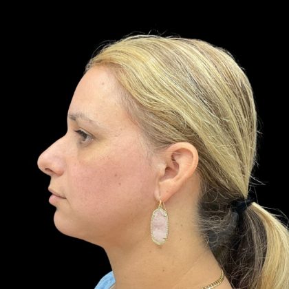 Vivace Before & After Patient #9688