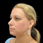 Vivace Before & After Patient #9688