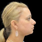 Vivace Before & After Patient #9688