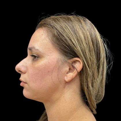 Vivace Before & After Patient #9688