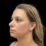 Vivace Before & After Patient #9688
