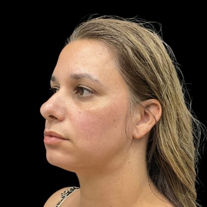 Vivace Before & After Patient #9688