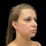 Vivace Before & After Patient #9688