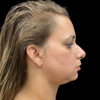 Vivace Before & After Patient #9688