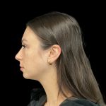 Lumecca Before & After Patient #10181