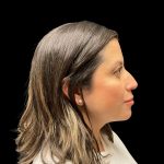 Liquid Rhinoplasty Before & After Patient #10182