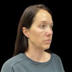 Sculptra Before & After Patient #10184