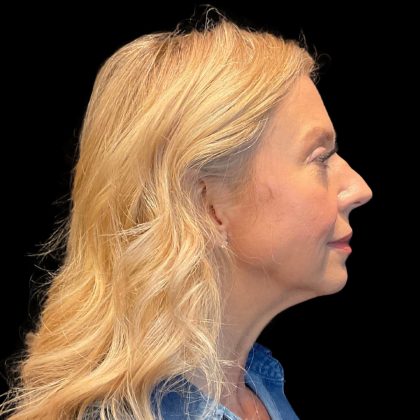 Hyper Dilute Radiesse Before & After Patient #10180