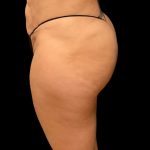 Aveli (Cellulite Removal) Before & After Patient #9762