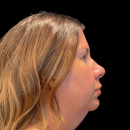 MyEllevate Before & After Patient #9824