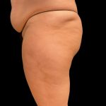 Aveli (Cellulite Removal) Before & After Patient #9762