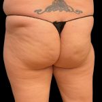 Aveli (Cellulite Removal) Before & After Patient #9762