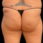 Aveli (Cellulite Removal) Before & After Patient #9762