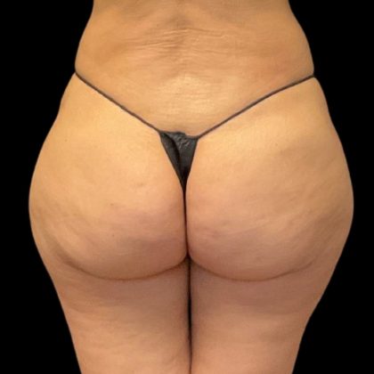 Aveli (Cellulite Removal) Before & After Patient #9731