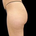 Aveli (Cellulite Removal) Before & After Patient #9775