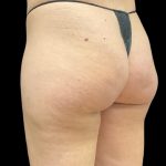 Aveli (Cellulite Removal) Before & After Patient #9775