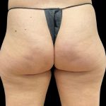 Aveli (Cellulite Removal) Before & After Patient #9775