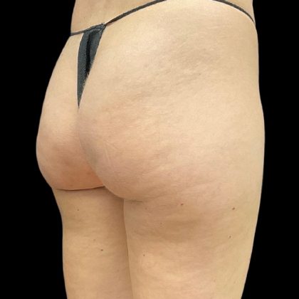 Aveli (Cellulite Removal) Before & After Patient #9775