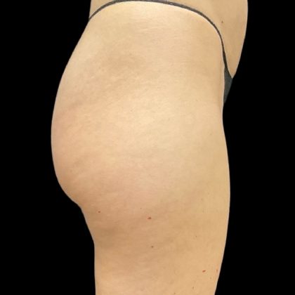 Aveli (Cellulite Removal) Before & After Patient #9775