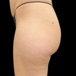 Aveli (Cellulite Removal) Before & After Patient #9775