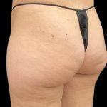 Aveli (Cellulite Removal) Before & After Patient #9775