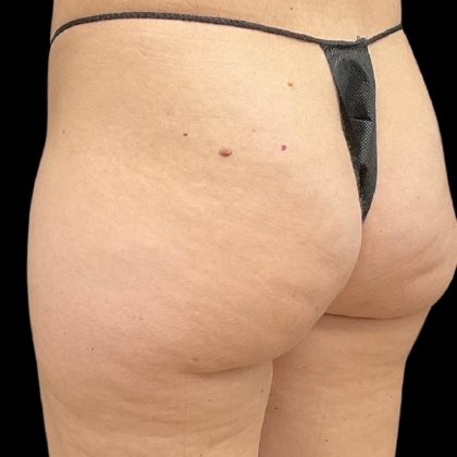 Aveli (Cellulite Removal) Before & After Patient #9775