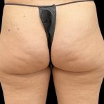 Aveli (Cellulite Removal) Before & After Patient #9775