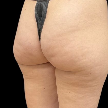 Aveli (Cellulite Removal) Before & After Patient #9775