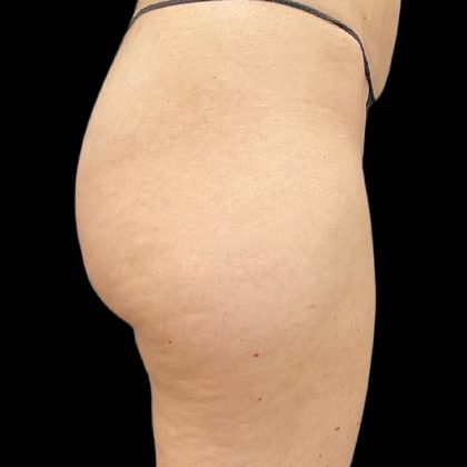 Aveli (Cellulite Removal) Before & After Patient #9775