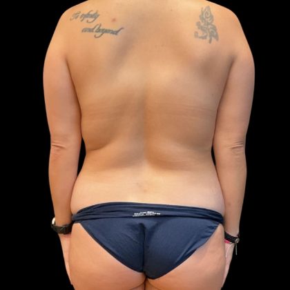 Mommy Makeover Before & After Patient #10154