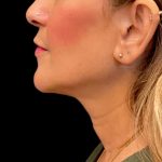 Sofwave Before & After Patient #9743