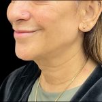 Sofwave Before & After Patient #9743