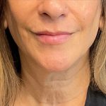 Sofwave Before & After Patient #9743