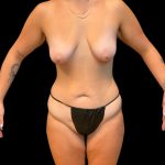 Soft Definition Liposuction Before & After Patient #10262